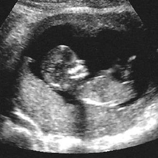 Recognizing Miscarriage