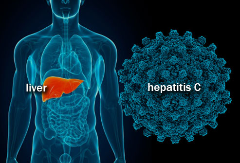 Hepatitis C