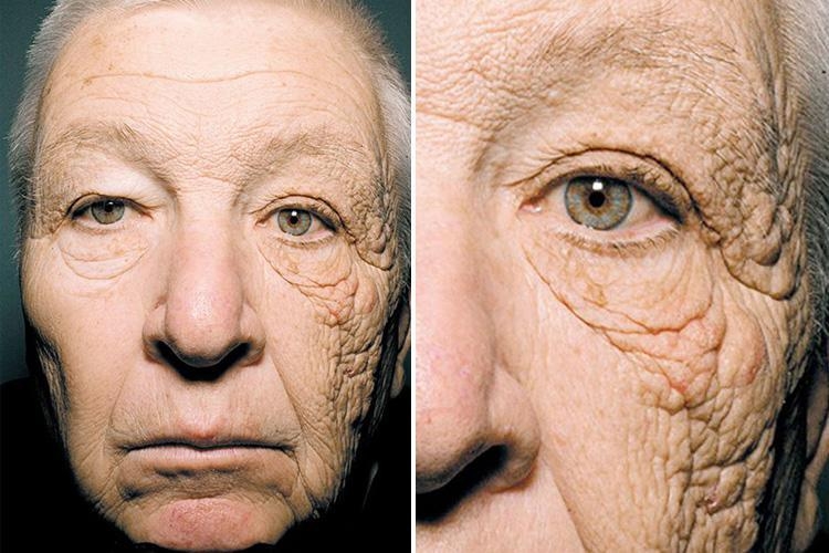 Photoaging Example