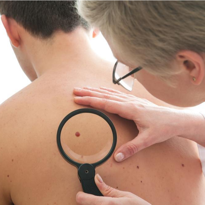 Do you know the types of moles on your body?