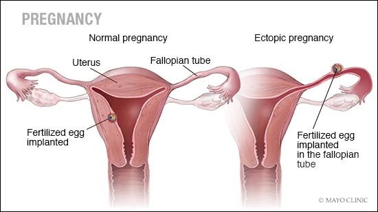 Ectopic Pregnancy Symptoms