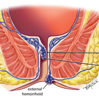 Hemorrhoids (Piles); Causes, Symptoms, Prevention, and Ways of Treatment