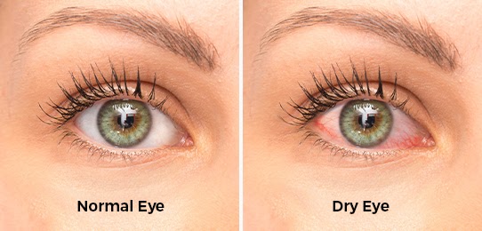 pezeshkbook.com - Causes of Dry Eye and its Treatments