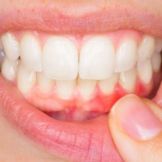 Immediate Treatment for Gingivitis at Home!